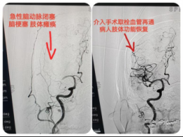 一个半小时！从肢体瘫痪到活动正常！突发急性脑梗死患者重获新生